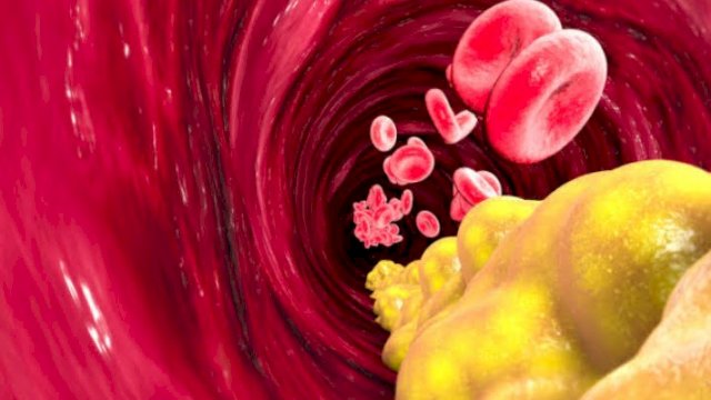Ilustrasi penyempitan pembuluh darah dan mengakibatkan penyakit Kolesterol. (foto: Google)