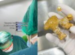 Viral Pasien dengan Batu Ginjal Sebesar Jahe, Ternyata Ini Penyebabnya