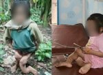 Viral Bocah di Nias Selatan Dianiaya Keluarga Hingga Alami Patah Kaki 