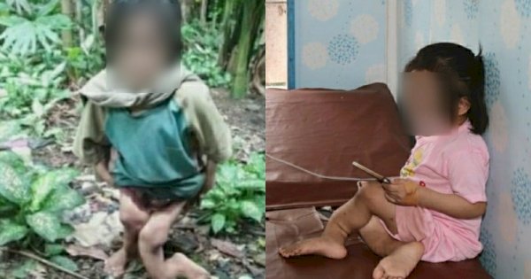 Viral Bocah di Nias Selatan Dianiaya Keluarga Hingga Alami Patah Kaki 