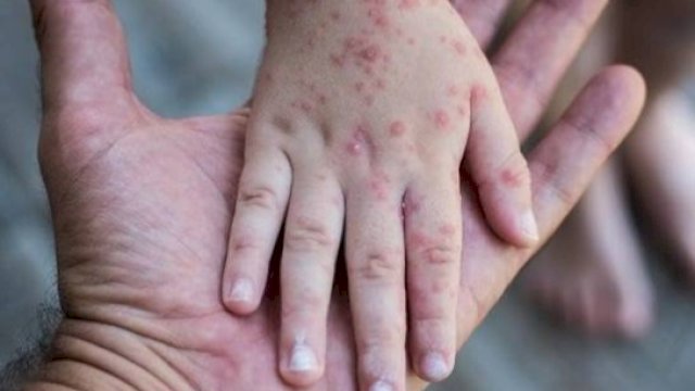 Ilustrasi penyakit Campak. 